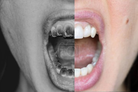Foto de La boca abierta de una chica con un cigarrillo encendido en lugar de dientes es un ejemplo antes y después de fumar, el daño de fumar, la adicción, los dientes malos - Imagen libre de derechos