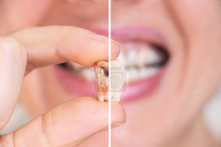 Téléchargez les photos : Une fille à la main tient une dent extraite divisée en deux parties, une moitié de la dent avec un trou noir au milieu de la dent, l'autre moitié est blanche, dent saine, traitement dentaire, dent extraite, dentisterie - en image libre de droit