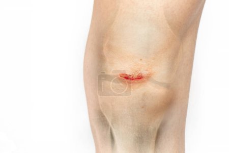 Blutüberströmte Wunden am Knie eines Mädchens nach einem Sturz und einem Röntgenbild ihres Beines, Unfall und Verletzung