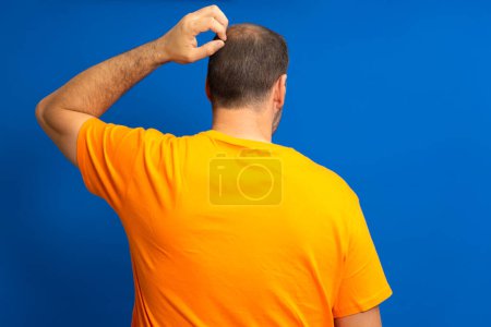 Photo for Man with hair loss problem close up, isolated. He alopecia bald hairs on the mans scalp. Human alopecia or hair loss. Scratching his head. Baldness. depression, stress - Royalty Free Image