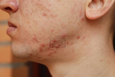 Pimples on face of young man, close up