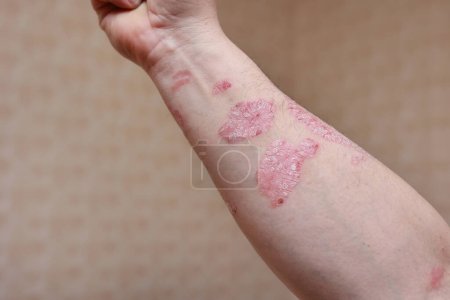 Man with sick arm, dry flaky skin on his hand with vulgar psoriasis sores, allergy, eczema and other skin diseases such as fungus, plaque, rash and blemishes. Autoimmune genetic disease