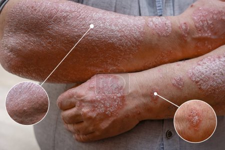 Téléchargez les photos : Macro-detailed circles psoriasis skin with different degrees of skin damage, wounds. Male arms with cracked, hard, horny, flaky skin. Dermatological problems of allergy, eczema.Hand stains, rash, dry. - en image libre de droit