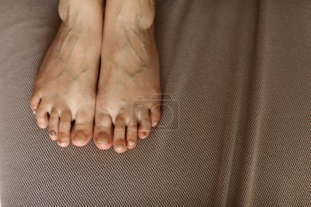 Foto de Pies de persona con hematoma subungueal, uñas de los pies negras causadas por trauma, infección fúngica o quimioterapia. Mujer que sufre de onicomicosis, una infección fúngica que causa coloración amarillenta de la uña del pie - Imagen libre de derechos