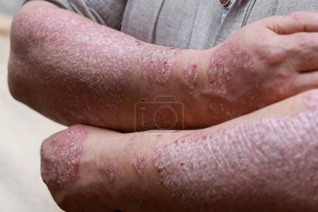 Foto de Psoriasis skin with red wounds. Male arms with cracked, hard, horny, flaky skin. Dermatological problems of allergy, eczema. Hand stains, rash, dry skin. The concept of chronic disease treatment. - Imagen libre de derechos