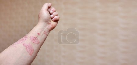 Photo for Man with sick arm, dry flaky skin on his hand with vulgar psoriasis sores, allergy, eczema and other skin diseases such as fungus, plaque, rash and blemishes. Autoimmune genetic disease - Royalty Free Image