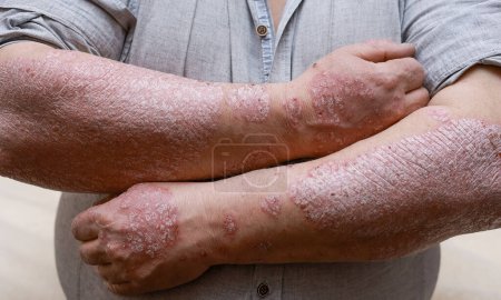 Téléchargez les photos : Psoriasis skin with red wounds. Male arms with cracked, hard, horny, flaky skin. Dermatological problems of allergy, eczema. Hand stains, rash, dry skin. The concept of chronic disease treatment. - en image libre de droit