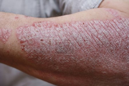 Nahaufnahme, Makro der Psoriasis-Haut, Autoimmunerkrankungen, die die Haut betreffen, verursachen Hautentzündungen rot und schuppig. Hautallergie mit schweren Symptomen. Hautausschlag und hässliche Ekzeme