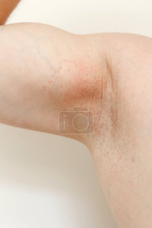 Allergy underarm. Cropped photo of irritation, inflammation on the sensitive skin after using a razor, trimmer, toxic deodorant or antiperspirant. Armpit rash. Atopic dermatitis. Acne or red spots