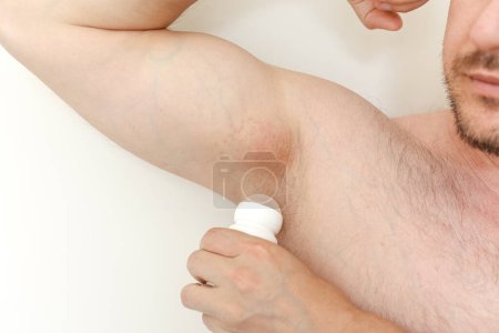 Cropped photo of irritation, inflammation on sensitive underarm skin after using toxic deodorant or antiperspirant. Armpit rash. Allergy, atopic dermatitis. Acne or red spots. Shaving effect.