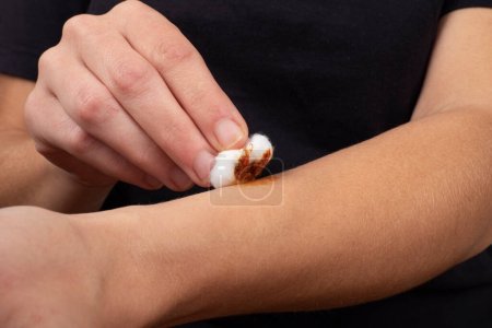 Photo for Cauterization of a wound on the arm with an iodine solution and cotton wool, health skin care - Royalty Free Image
