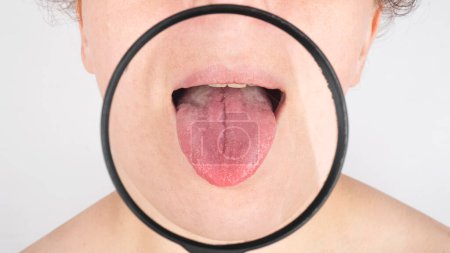 Foto de Examen médico de la lengua de un paciente con gastritis capa blanca, cáncer de lengua. - Imagen libre de derechos