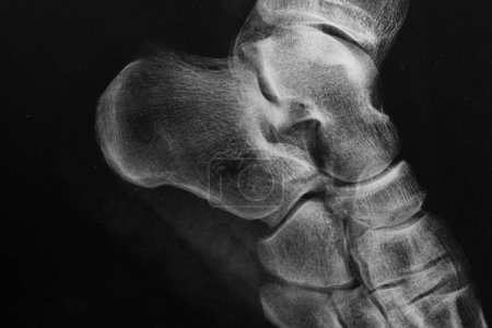Téléchargez les photos : Détail de la radiographie d'un pied humain en noir et blanc - en image libre de droit
