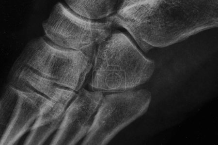 Téléchargez les photos : Détail de la radiographie d'un pied humain en noir et blanc - en image libre de droit