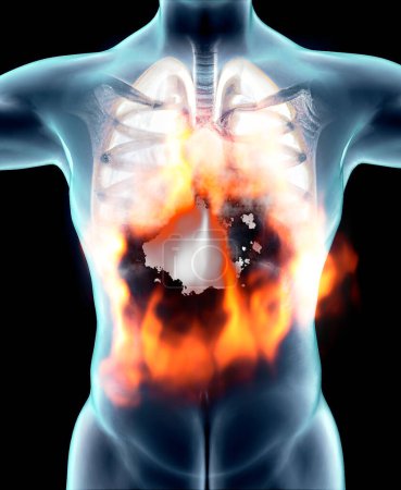Photo for Human anatomy, problems with the respiratory system, severely damaged lungs. Bilateral pneumonia. Covid-19, coronavirus. Patient and smoke. Smoker. Burn and fire. 3d rendering - Royalty Free Image