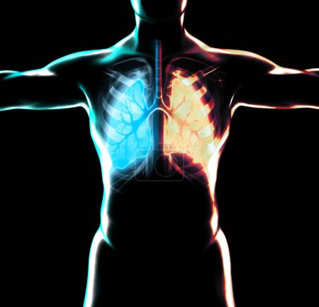 Photo for Human anatomy, human body divided in half: healthy lungs and bronchi, problems with the respiratory system, severely damaged lungs. Phlegm. Pneumonia Patient and smoke. 3d rendering - Royalty Free Image