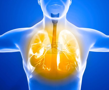 Die menschliche Anatomie, Probleme mit den Atemwegen, stark geschädigte Lungen. Bilaterale Lungenentzündung. Covid-19, coronavirus. Patient und Rauch. Raucher. 3D-Darstellung