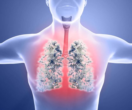 Photo for Human anatomy, problems with the respiratory system, severely damaged lungs. Bilateral pneumonia. Covid-19, coronavirus. Patient and smoke. Smoker. 3d render - Royalty Free Image