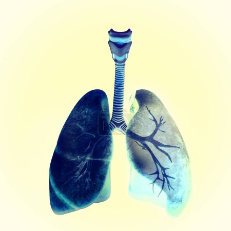 Foto de Vista de rayos X de pulmones y tráquea, infección pulmonar. Neumonía. renderizado 3d - Imagen libre de derechos