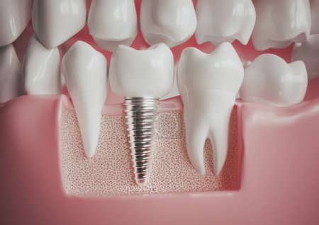 Photo for Implant next to a healthy molar -- 3D rendering - Royalty Free Image