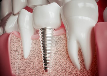 Foto de Implante junto a un molar saludable - 3D renderizado - Imagen libre de derechos