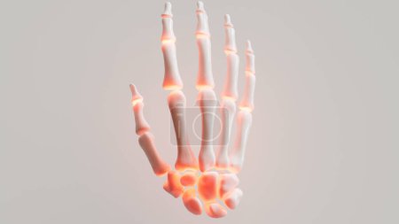 Foto de Artritis reumatoide sobre fondo blanco - - representación 3D - Imagen libre de derechos