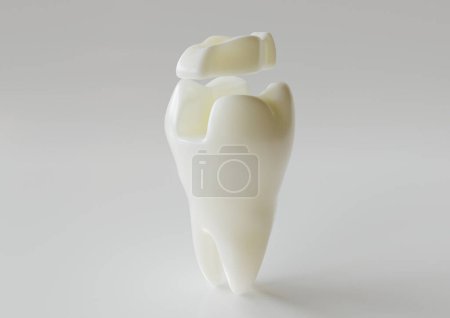 Photo for Ceramic Inlay crown over a totth - 3D Rendering - Royalty Free Image