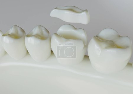 Photo for Ceramic Inlay crown over a totth - 3D Rendering - Royalty Free Image