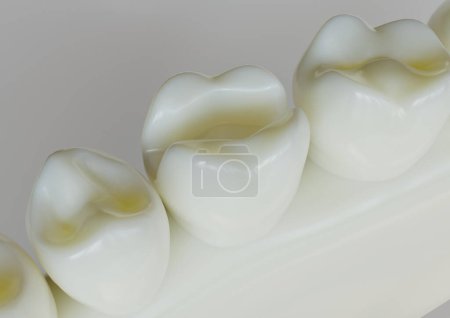 Photo for Removed amalgam filling from a tooth -- 3D Rendering - Royalty Free Image