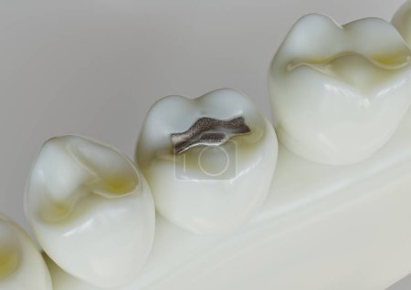 Photo for Amalgam restorationn in a tooth -- 3D Rendering - Royalty Free Image
