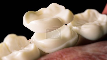 Corona de recubrimiento de cerámica sobre una representación 3D de dientes