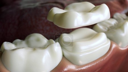 Photo for Ceramic Overlay crown over a tooth--- 3D Rendering - Royalty Free Image