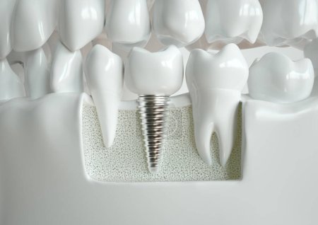 Zahnimplantat eingebettet zwischen zwei gesunden Zähnen, dargestellt in einem Querschnitt durch den Kiefer.