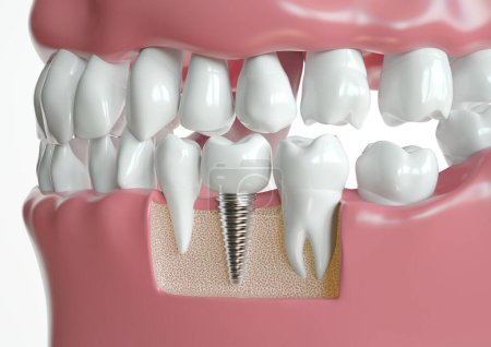 Zahnimplantat eingebettet zwischen zwei gesunden Zähnen, dargestellt in einem Querschnitt durch den Kiefer.