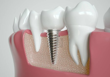 Dental implant nestled between two healthy teeth, depicted in a cross-section through the jaw.