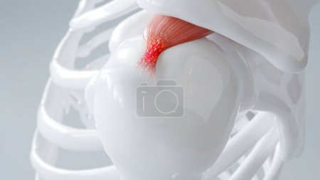 Foto de Visualización 3D de un hombro con tendinitis calcifica, destacando la inflamación. - Imagen libre de derechos