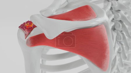 Foto de Representación en 3D simplificada de una articulación del hombro con colores y texturas básicas para resaltar áreas de tendinitis calcifica. - Imagen libre de derechos