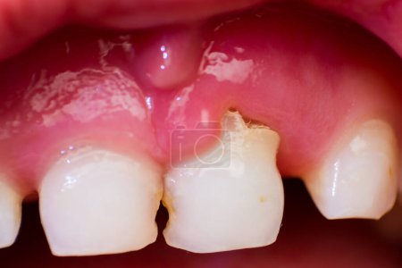 image en gros plan d'une dent incisive qui est sur le point d'éclater chez un enfant de 7 ans