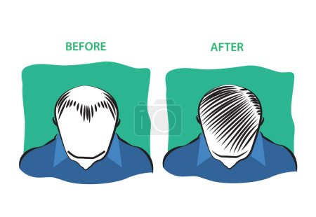 Téléchargez les illustrations : Traitement de perte de cheveux avant et après diagramme. Clip Art modifiable - en licence libre de droit