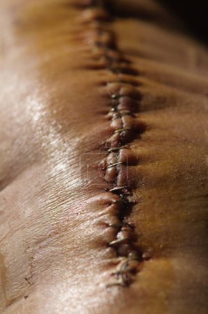 Surgical suture on the knee. Surgical wound sutured with special metal suture for healing. Total knee joint replacement. Close-up.