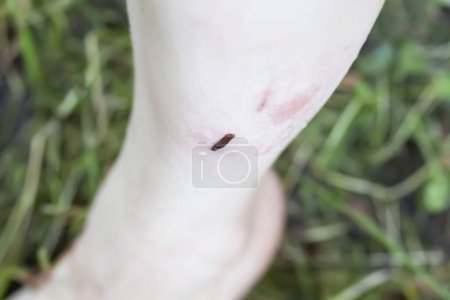 Foto de Una sanguijuela muerde la pierna de una mujer. - Imagen libre de derechos