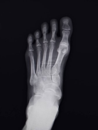 Foto de X-ray of the right foot of an adult woman in overhead and subjective view. - Imagen libre de derechos