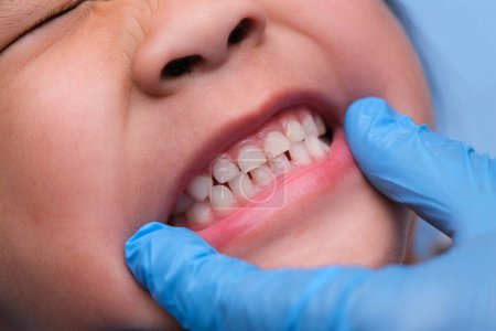 Großaufnahme in der Mundhöhle eines gesunden Kindes mit schönen Reihen von Babyzähnen. Junges Mädchen öffnet Mund und zeigt obere und untere Zähne, harten Gaumen, weichen Gaumen, zahnärztliche und orale Gesundheitsprüfung.