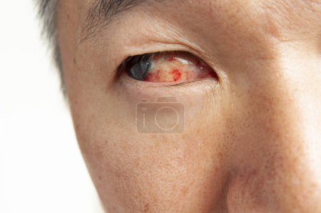 Foto de Hombre asiático ojo derecho primer plano con el ojo enrojecido. - Imagen libre de derechos