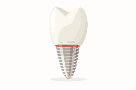 Téléchargez les illustrations : Implant dentaire style vecteur isolé - en licence libre de droit