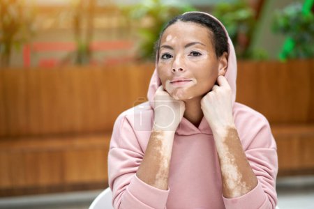 Femme noire afro-américaine avec problème de peau de pigmentation vitiligo habillé intérieur sweat à capuche rose mis sur une capuche portrait rapproché avec la main près du visage