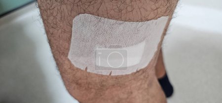 Photo for Leg injured by a cut. Surgical sutures made by a surgeon, Stitches fresh would, hospital and insurance - Royalty Free Image
