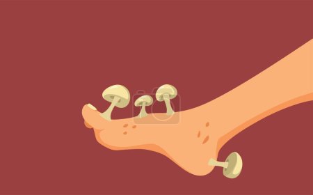 Illustration for Foot with Fungus Problem Concept Cartoon Illustration - Royalty Free Image