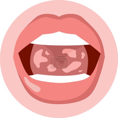 Téléchargez les illustrations : Illustration vectorielle d'une bouche atteinte d'infection à Candidose - en licence libre de droit