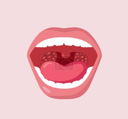 Ilustración de Inflamación de las amígdalas Concepto vectorial Imagen de una boca abierta - Imagen libre de derechos